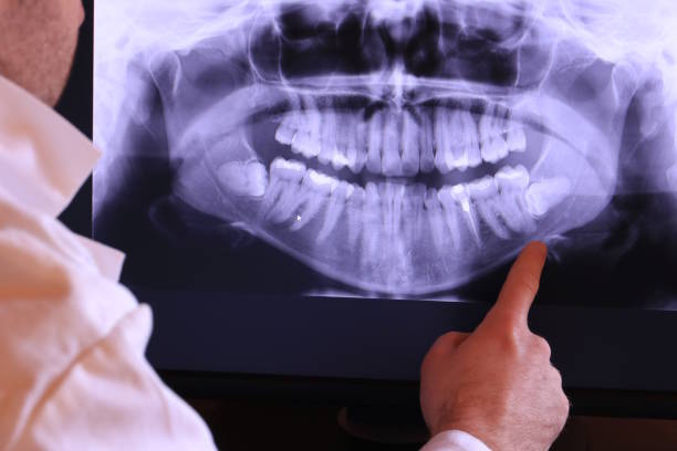 Best Emergency Wisdom Teeth Removal in Lockport, IL
